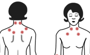 Fibromyalgia