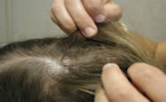Head LIce