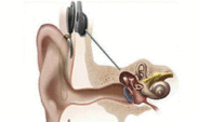 Hearing Loss