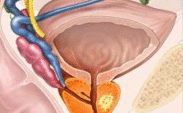 Prostate Cancer
