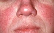 Rosacea