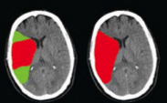 Stroke