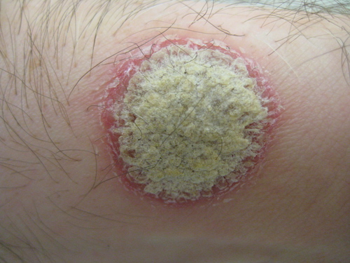 Plaque psoriasis lesion