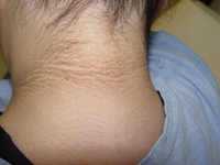 Acanthosis nigricans