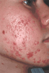 Boy with acne before treatment