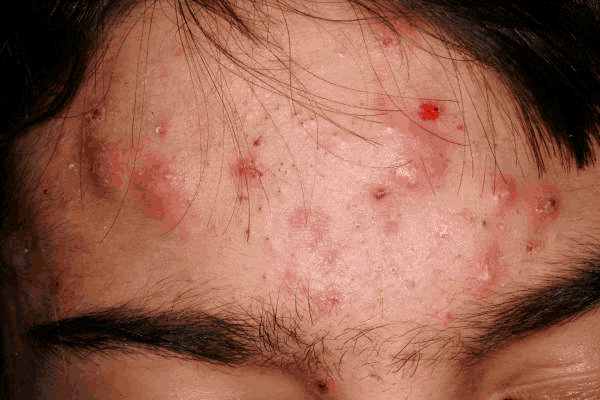 Acne - severe, cystic acne on forehead