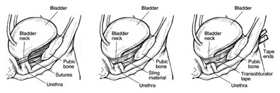 Surgical treatment of urinary incontinence with sling