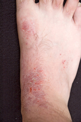 Eczema Dermatologist Recommended Skin Info