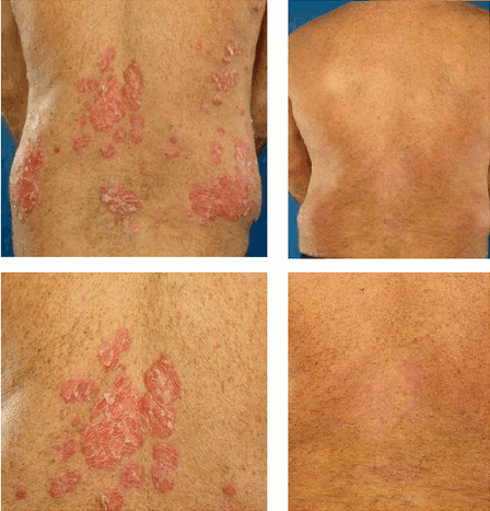 Psoriasis Treatment Results