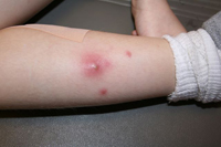 Boils, carbuncles and skin infections from staph