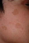 Brown spots on a boy's face before treatment