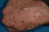 Brown spots on hand before treatment