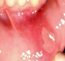 Canker sore in mouth