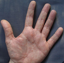 Dyshidrotic Eczema or Pompholyx