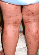 Atopic dermatitis before treatment