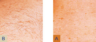 Elite Platform Before and After Vein Removal