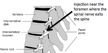Epidural spinal nerve injection for nerve pain