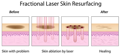 fractional laser