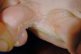 Athlete's foot infection (tinea pedis)