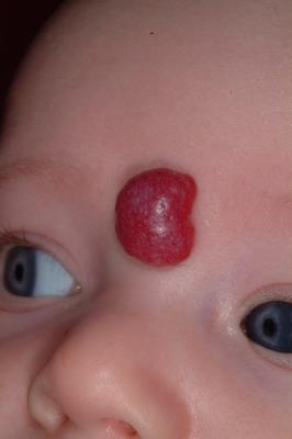 Hemangioma before treatment