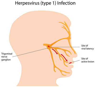 Herpes cold sore virus reactivation causing a flare