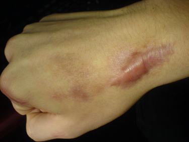 Keloid Scar on Hand