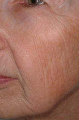 Laser rejuvenation - after treatment