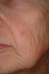 Laser rejuvenation - before treatment