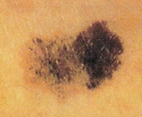 Skin Cancer: Melanome assymetry shape