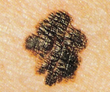 Skin Cancer: Melanoma border