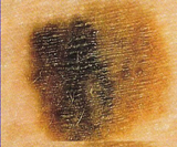 Skin Cancer: Melanoma color