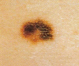 Skin Cancer: Melanoma diameter
