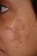 Melasma before treatment