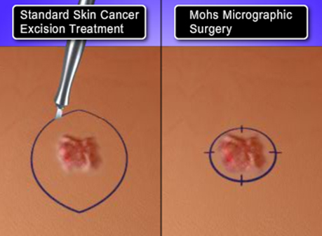 Mohs Surgery compared to standard skin cancer surgery