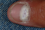 Fungal infection of the toenail (onychomycosis)