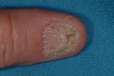 Fungal Nail Infection before treatment