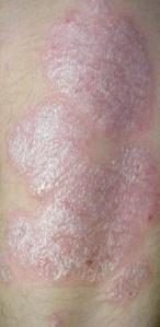 Psoriasis Lesion