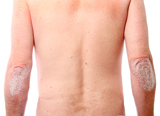 Psoriasis on Elbows
