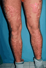 Psoriasis Before Treatment