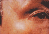 Wrinkles after treatment with a retinoid
