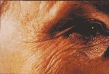 Wrinkles before treatment with a retinoid