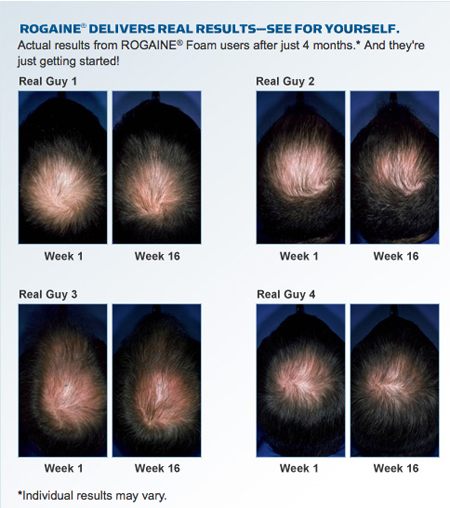 Iogaine for Hair Loss Results
