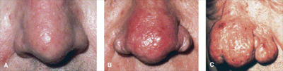 Rosacea Rhinophyma