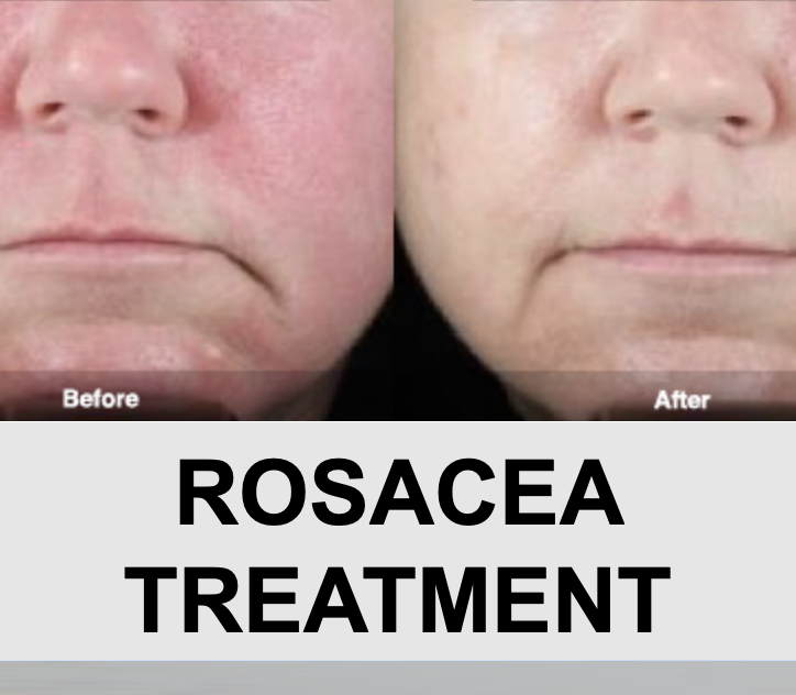 Rosacea - Stick to Your Treatment