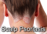 Scalp Psoriasis