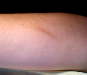 Scar on Arm