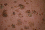 Seborrheic keratosis