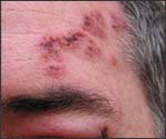 Shingles Rash (Herpes Zoster)