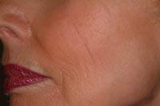 Basal Cell Carcinoma After Treatment