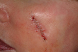 Skin Cancer: Basal Cell excision